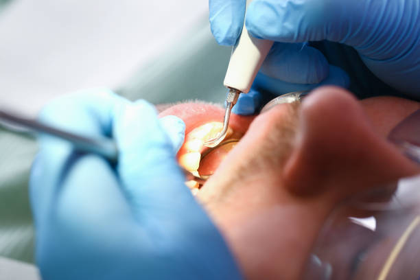 Best Emergency Treatment for Dental Infections or Abscesses in Mission Nyon, CA