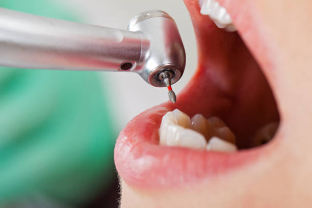 Best Emergency Root Canal Treatment in Mission Nyon, CA